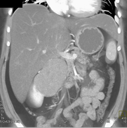 Oncocytic Renal Cell Carcinoma (RCC) Looks Like Peripancreatic Mass- Fooled Me - CTisus CT Scan