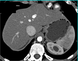 Dilated Calyx Upper Pole of Left Kidney - CTisus CT Scan