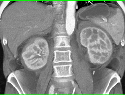 Retroperitoneal Fibrosis - CTisus CT Scan