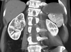 Intrarenal Renal Cell Carcinoma - CTisus CT Scan