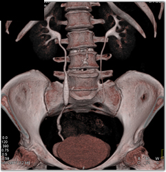 Dilated Right Ureter - CTisus CT Scan