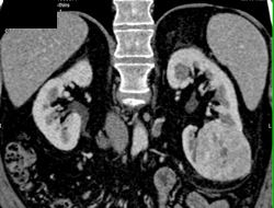 Oncocytoma - CTisus CT Scan