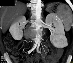 Oncocytoma - CTisus CT Scan