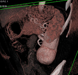 Oncocytoma - CTisus CT Scan