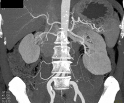 Oncocytoma - CTisus CT Scan