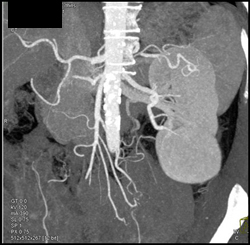 Oncocytoma - CTisus CT Scan