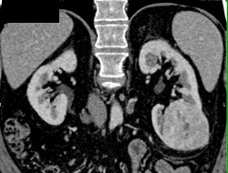 Oncocytoma - CTisus CT Scan