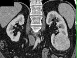 Oncocytoma - CTisus CT Scan