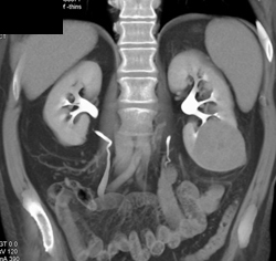 Oncocytoma - CTisus CT Scan
