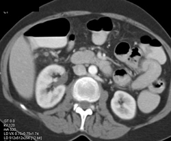 Retroaortic Renal Vein - CTisus CT Scan