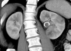 Acute Pyelonephritis - CTisus CT Scan