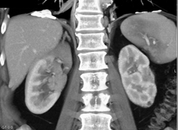 Transitional Cell Carcinoma - CTisus CT Scan