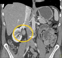 Transitional Cell Carcinoma - CTisus CT Scan
