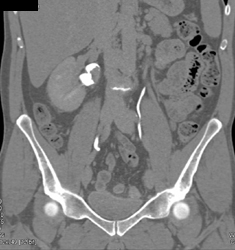 Transitional Cell Carcinoma - CTisus CT Scan