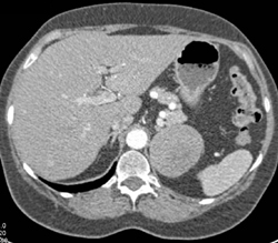 Renal Cell Carcinoma and Adrenal Metastases - CTisus CT Scan