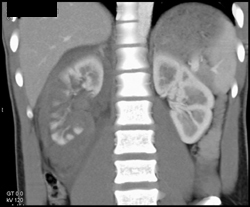 Renal Laceration - CTisus CT Scan