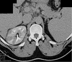 Acute Pyelonephritis - CTisus CT Scan