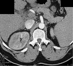 Acute Pyelonephritis - CTisus CT Scan