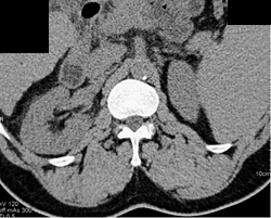 Acute Pyelonephritis - CTisus CT Scan