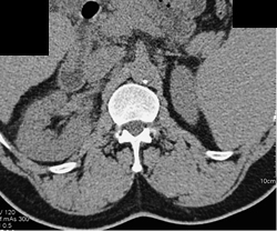 Acute Pyelonephritis - CTisus CT Scan