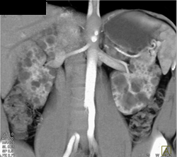 Polycystic Kidney Disease in A Range of Phases and Renderings - CTisus CT Scan