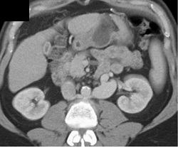 Large Renal Vein Due to Splenorenal Shunting - CTisus CT Scan