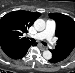 Pulmonary Embolism (PE) and Right Atrial Thrombus - CTisus CT Scan