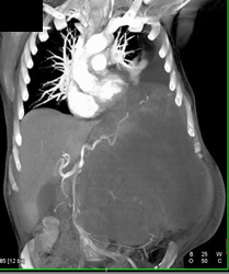 Huge Renal Cell Carcinoma - CTisus CT Scan
