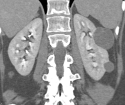 Renal Cysts- Simple - CTisus CT Scan