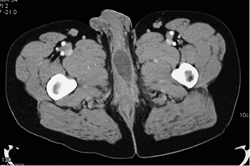 Periurethral Abscess - CTisus CT Scan