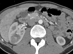 Acute Pyelonephritis - CTisus CT Scan