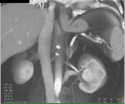 Renal Cell Carcinoma - CTisus CT Scan