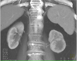 Renal Cell Carcinoma - CTisus CT Scan