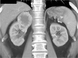 Renal Cell Carcinoma - CTisus CT Scan