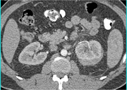 Acute Pyelonephritis - CTisus CT Scan