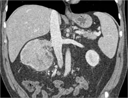 Renal Cell Carcinoma - CTisus CT Scan