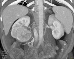 Renal Cell Carcinoma - CTisus CT Scan