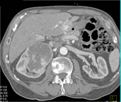 Renal Cell Carcinoma - CTisus CT Scan