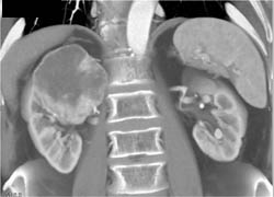 Renal Cell Carcinoma - CTisus CT Scan