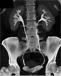 Normal CT Urogram - CTisus CT Scan