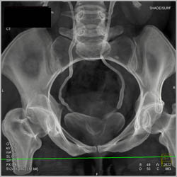 Normal CT Urogram - CTisus CT Scan