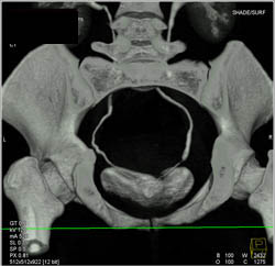 Normal CT Urogram - CTisus CT Scan
