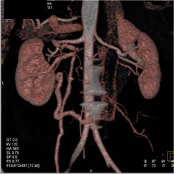 Prominent Left Gonadal Vein - CTisus CT Scan