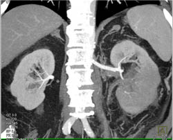 Transitional Cell Cancer (TCC) Invades Left Renal Vein - CTisus CT Scan