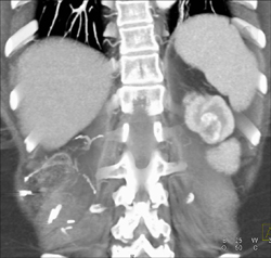 Renal Cell Carcinoma - CTisus CT Scan