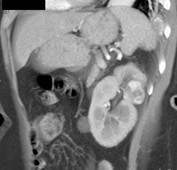 Renal Cell Carcinoma - CTisus CT Scan