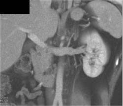 Normal Renal and Adrenal Vein - CTisus CT Scan