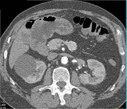 Renal Cyst - CTisus CT Scan