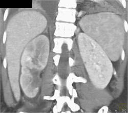 Acute Pyelonephritis - CTisus CT Scan