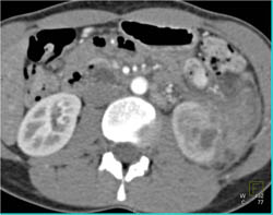Renal Abscess - CTisus CT Scan